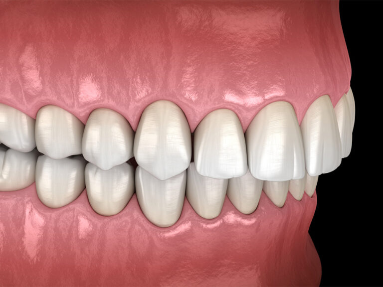 illustration showing teeth with an overbite