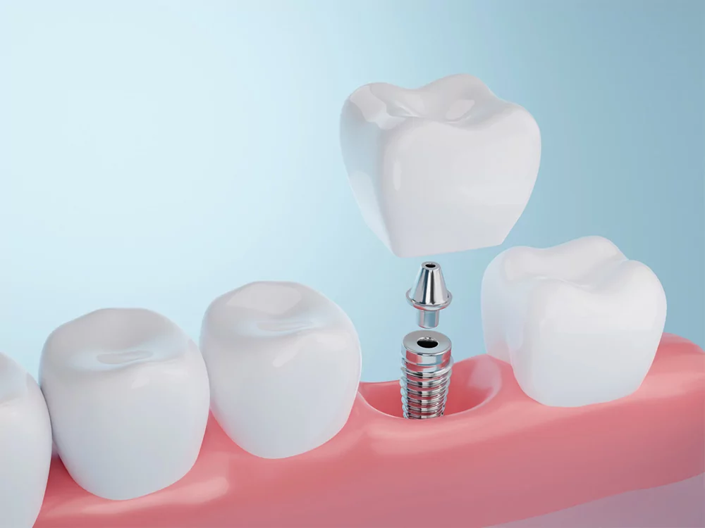 Dental Implant Being Fitted into Jaw Showing Post, Abutment and Crown