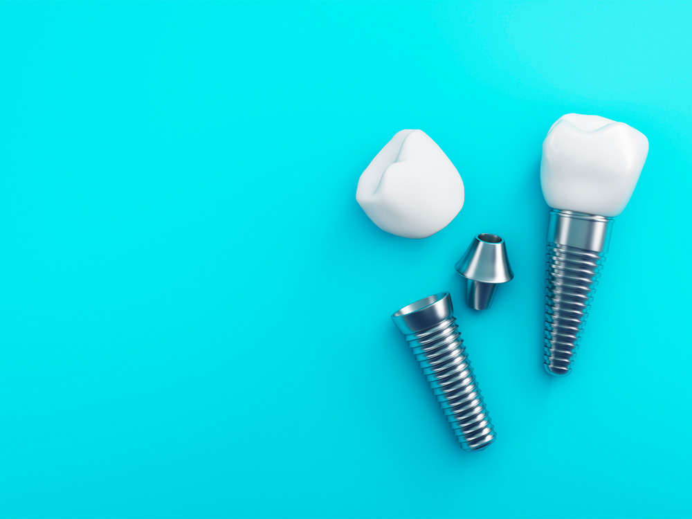 Dental Implant Showing Crown, Post and Abutment on Light Blue Background