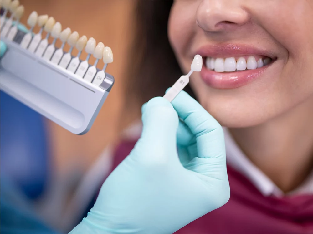 woman having her teeth color matched to prepare for a whitening treatment